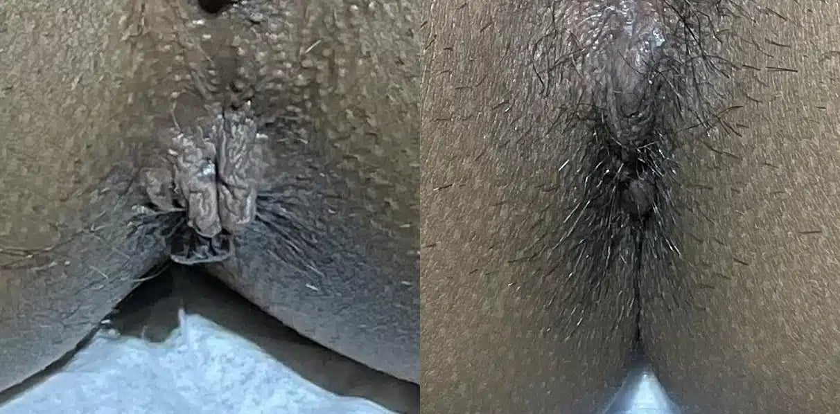 Anal Skin Tag Removal before and after photos by The Cosmetic Gyn: Dr. Michael Reed in Davis, CA