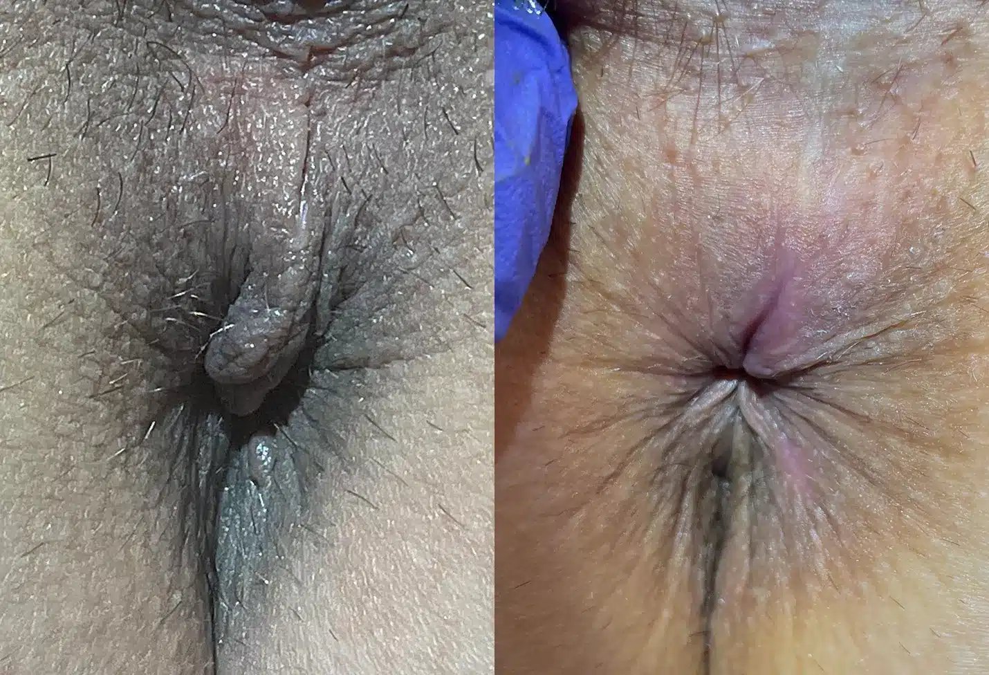 Anal Skin Tag before and after photos by The Cosmetic Gyn Dr. Michael Reed in Davis, CA