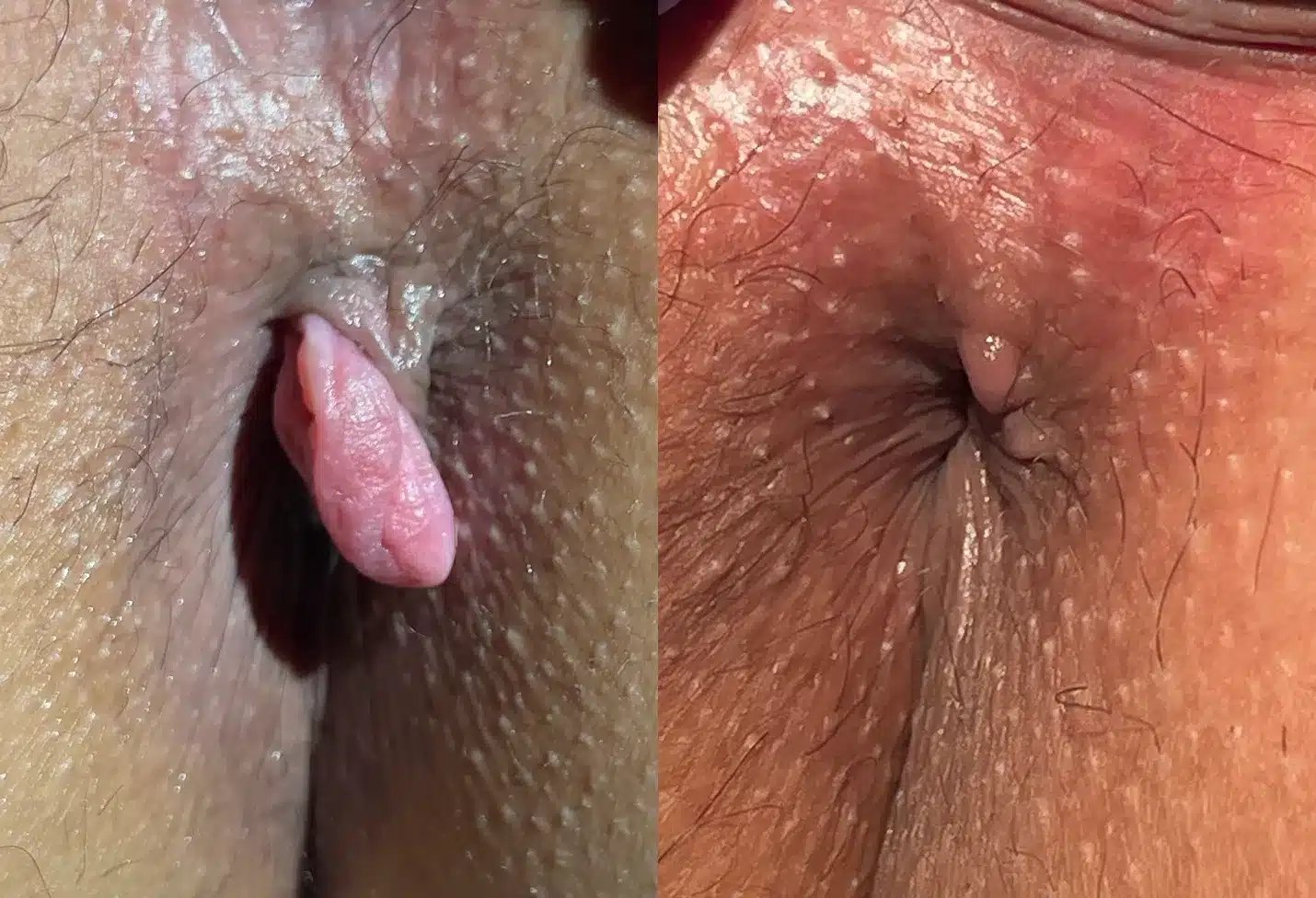 Anal Skin Tag before and after photos by The Cosmetic Gyn Dr. Michael Reed in Davis, CA