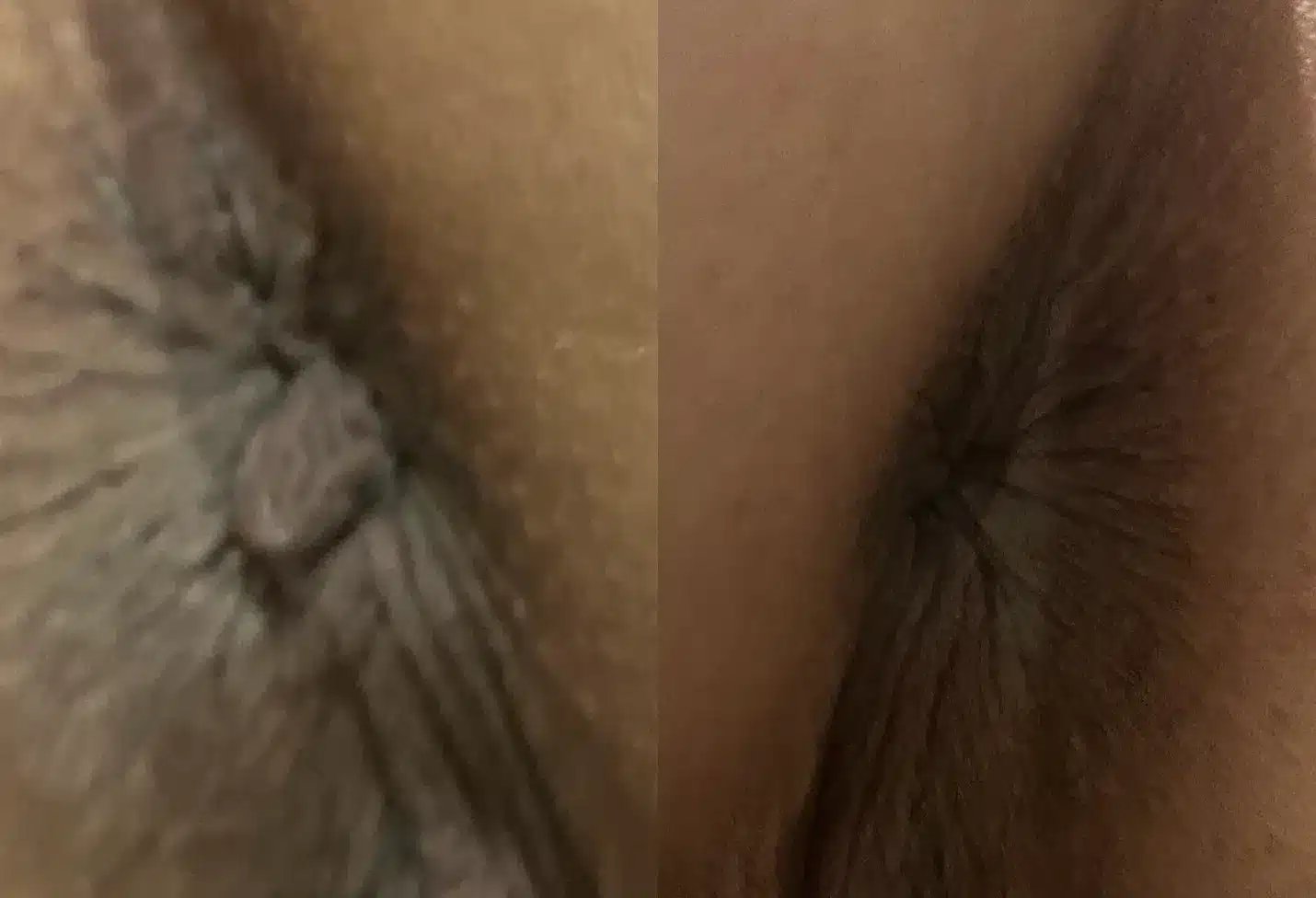 Anal Skin Tag before and after photos by The Cosmetic Gyn Dr. Michael Reed in Davis, CA