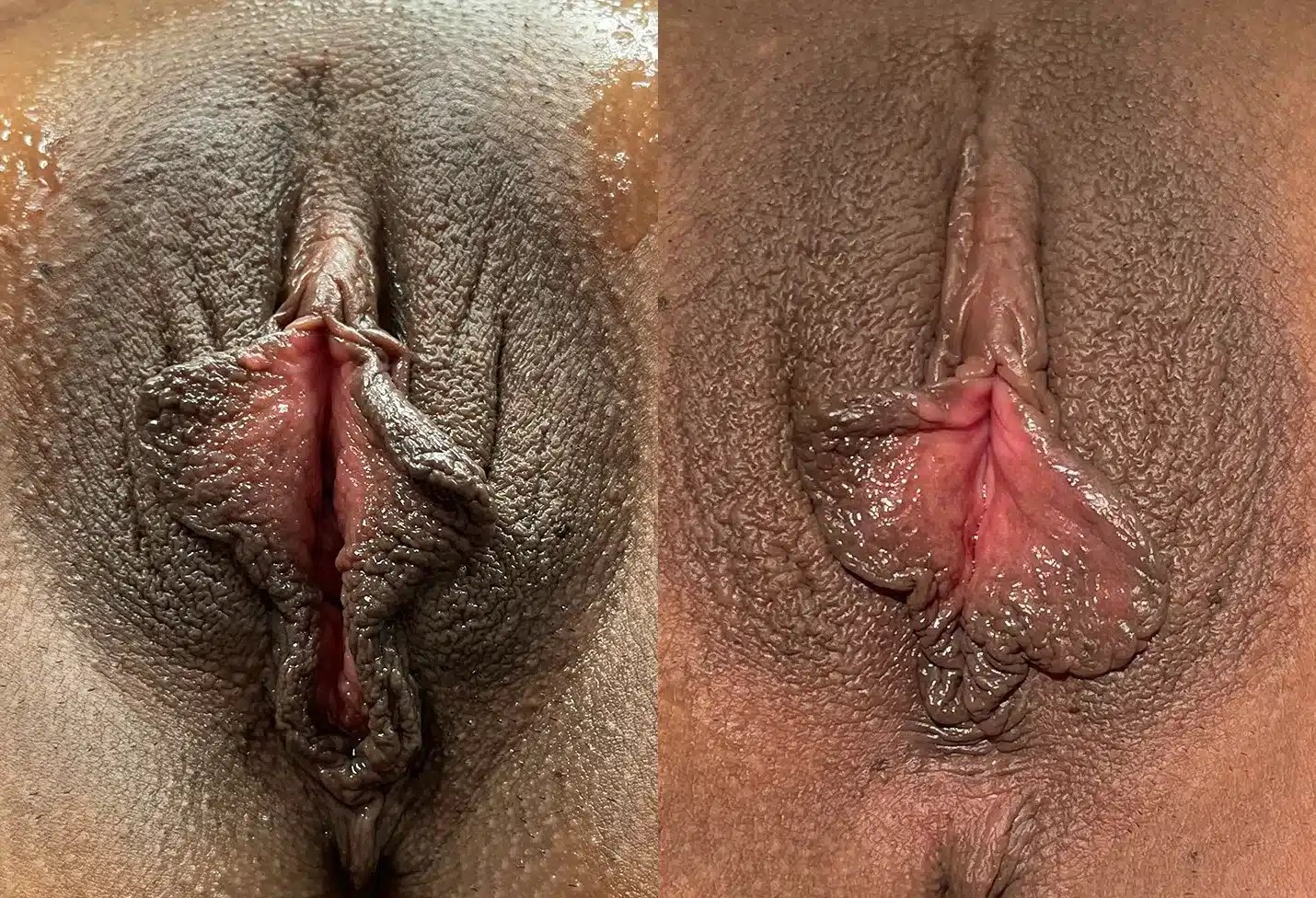 Vaginoplasty and perineoplasty before and after results