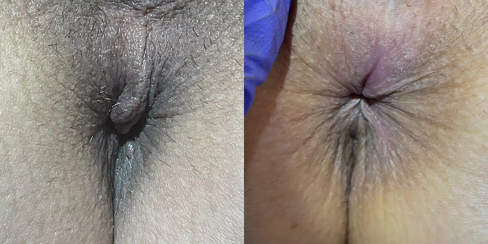 Anal Skin Tag Removal before and after photos by The Cosmetic Gyn: Dr. Michael Reed in Davis, CA