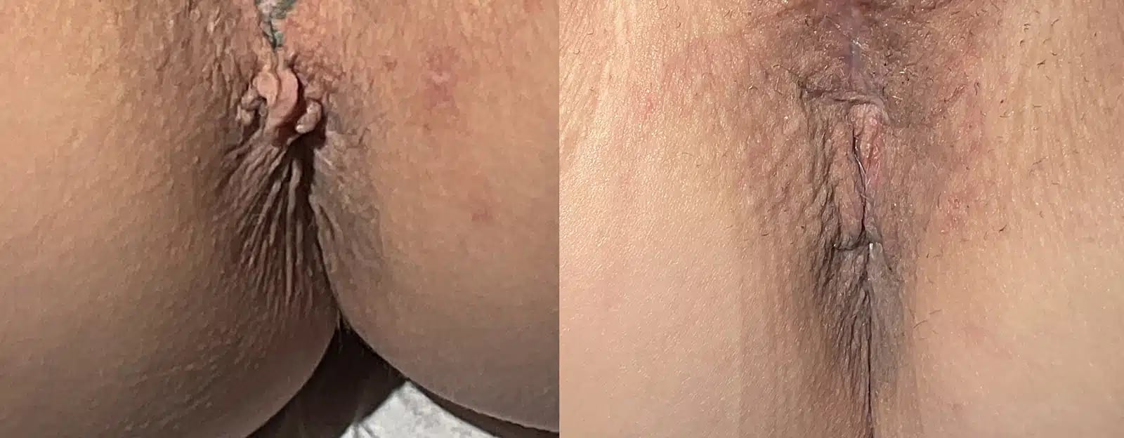 Anal Skin Tag Removal before and after photos by The Cosmetic Gyn: Dr. Michael Reed in Davis, CA