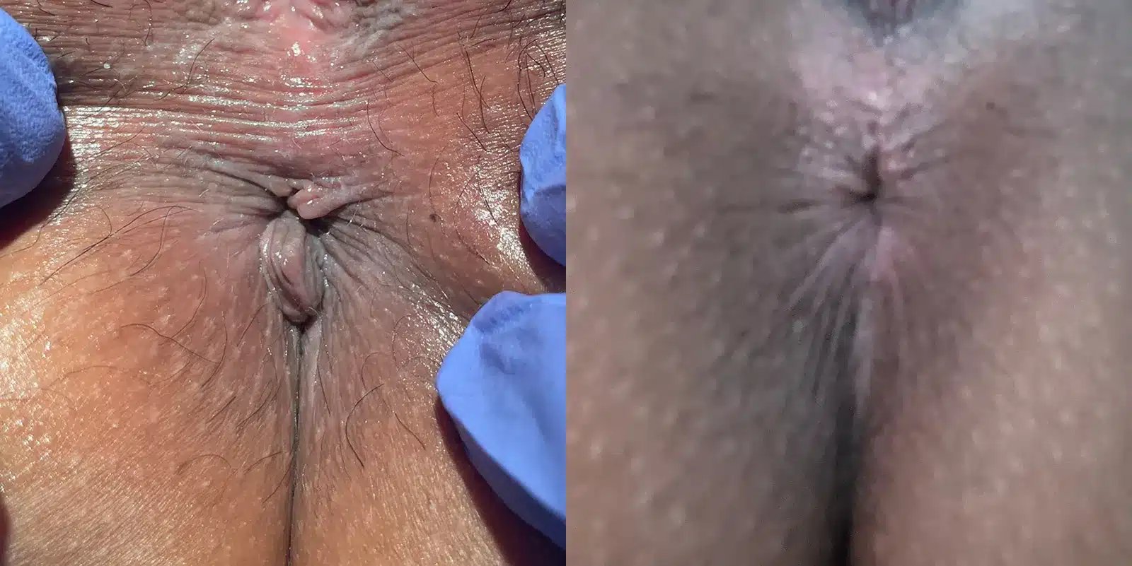 Anal Skin Tag Removal before and after photos by Dr. Michael Reed