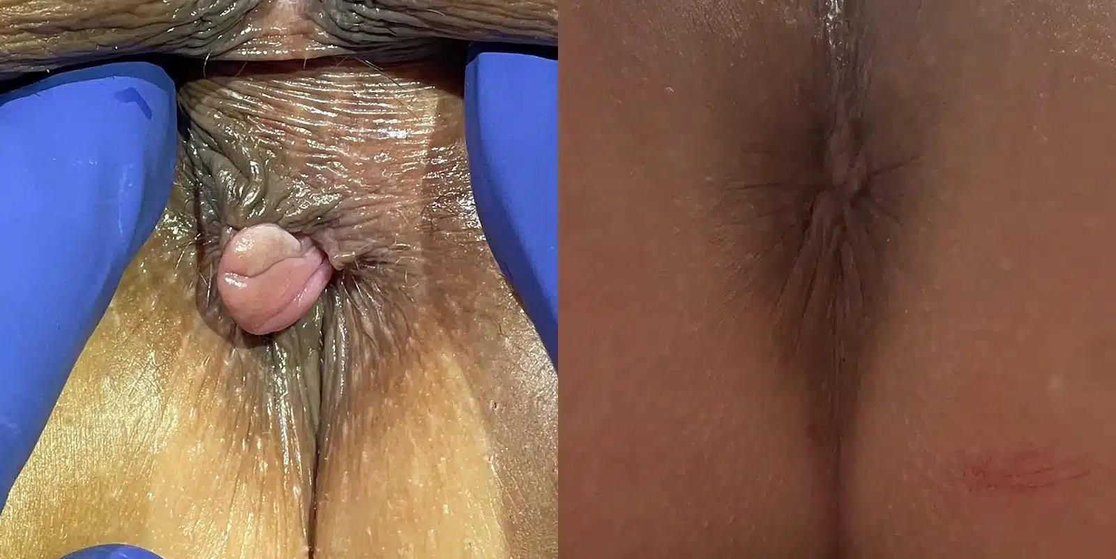 Anal Skin Tag Removal before and after photos by Dr. Michael Reed