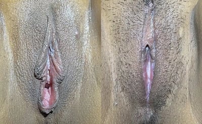 Combination Procedures before and after photos by The Cosmetic Gyn: Dr. Michael Reed in Davis, CA