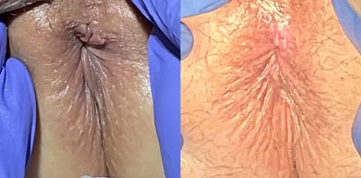Anal Skin Tag Removal before and after photos by The Cosmetic Gyn: Dr. Michael Reed in Davis, CA