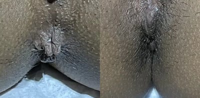 Anal Skin Tag Removal before and after photos by The Cosmetic Gyn: Dr. Michael Reed in Davis, CA
