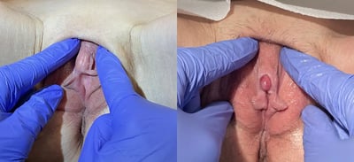Clitoral Unhooding before and after photos by The Cosmetic Gyn: Dr. Michael Reed in Davis, CA