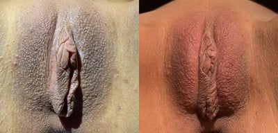 Vampire Lift before and after photos by The Cosmetic Gyn: Dr. Michael Reed in Davis, CA