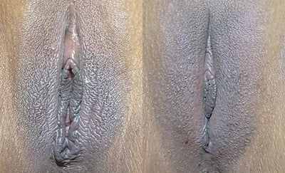 Vampire Lift before and after photos by The Cosmetic Gyn: Dr. Michael Reed in Davis, CA