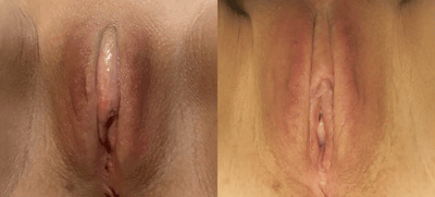 Clitoral Unhooding before and after photos by The Cosmetic Gyn: Dr. Michael Reed in Davis, CA