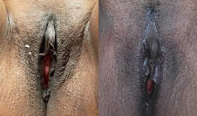 Labia Majoraplasty before and after photos by The Cosmetic Gyn: Dr. Michael Reed in Davis, CA