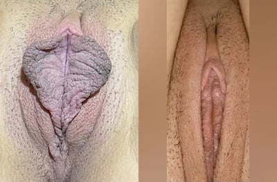 Labiaplasty before and after photos by The Cosmetic Gyn: Dr. Michael Reed in Davis, CA