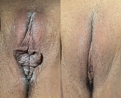 Labiaplasty before and after photos by The Cosmetic Gyn: Dr. Michael Reed in Davis, CA