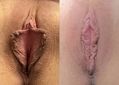 Labiaplasty before and after photos by The Cosmetic Gyn: Dr. Michael Reed in Davis, CA