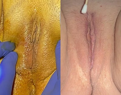 Reviv before and after photos by The Cosmetic Gyn: Dr. Michael Reed in Davis, CA