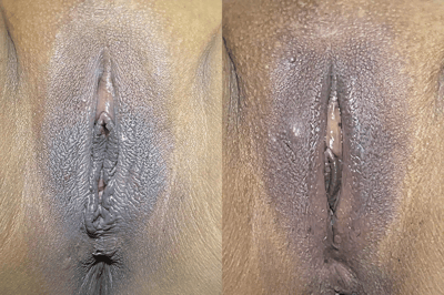 Before and after second vaginoplasty for tighter vagina