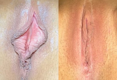 Combination Procedures before and after photos by The Cosmetic Gyn Dr. Michael Reed in Davis, CA