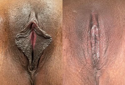 Combination Procedures before and after photos by The Cosmetic Gyn Dr. Michael Reed in Davis, CA