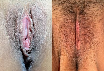 Perineoplasty and vaginoplasty for improved vaginal opening