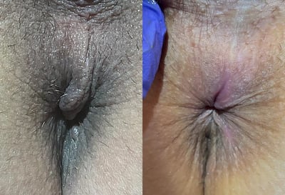 Anal Skin Tag before and after photos by The Cosmetic Gyn Dr. Michael Reed in Davis, CA