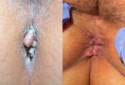 Anal Skin Tag before and after photos by The Cosmetic Gyn Dr. Michael Reed in Davis, CA