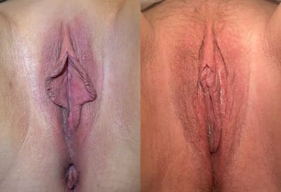 Combined Procedures before and after photos by The Cosmetic Gyn Dr. Michael Reed in Davis, CA