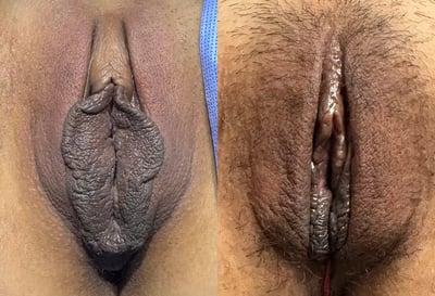 Labiaplasty before and after photos by The Cosmetic Gyn Dr. Michael Reed in Davis, CA