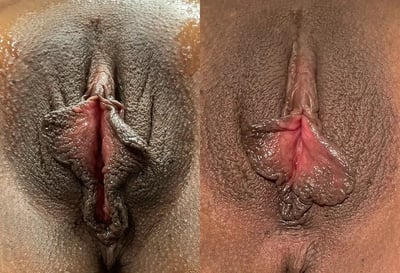 Vaginoplasty and perineoplasty before and after results