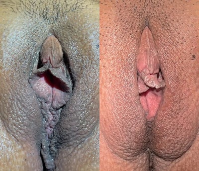 Vaginoplasty + Perineoplasty before and after photos by Dr. Michael Reed