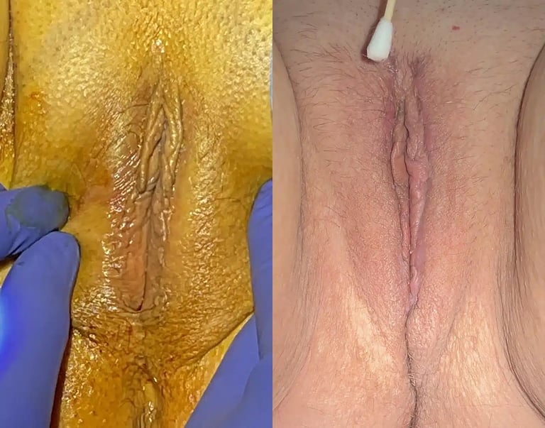 Reviv before and after photos by The Cosmetic Gyn: Dr. Michael Reed in Davis, CA