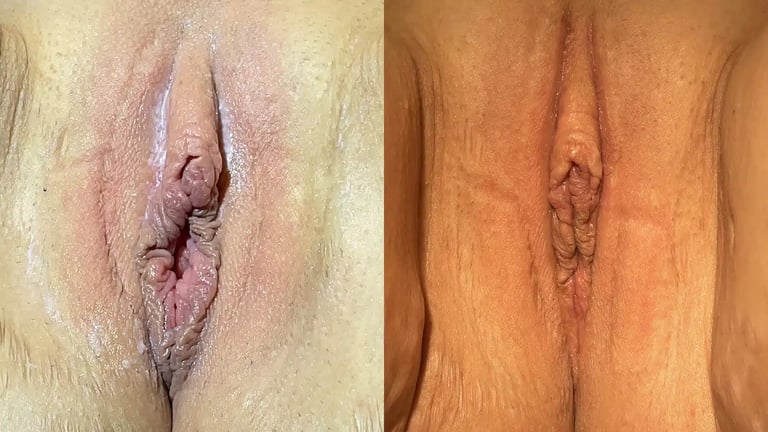 Reviv before and after photos by The Cosmetic Gyn: Dr. Michael Reed in Davis, CA